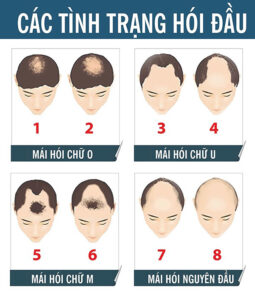 Hói đầu ảnh hưởng rất nhiều đến cuộc sống của bạn 